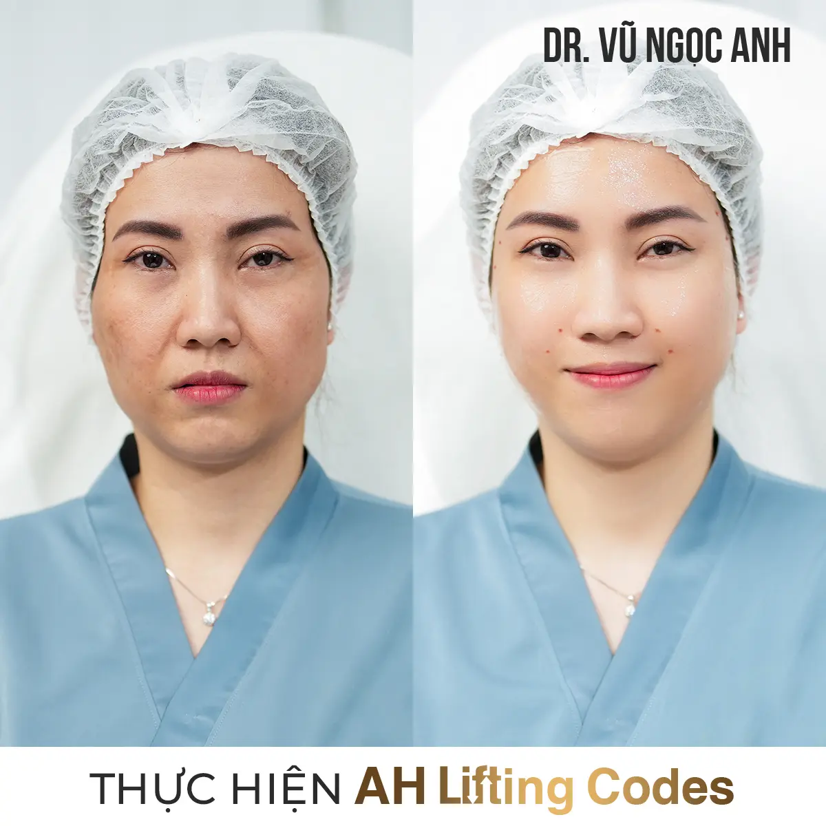 Dịch vụ 14 khách hàng sau khi thực hiện liệu trình AH Lifting Codes 4
