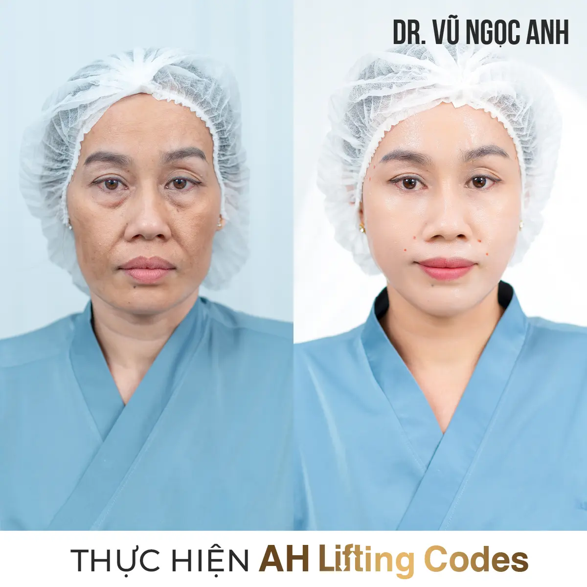 Dịch vụ 16 khách hàng sau khi thực hiện liệu trình AH Lifting Codes 6