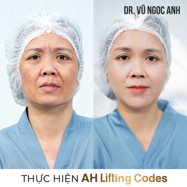 Dịch vụ 11 khách hàng sau khi thực hiện liệu trình AH Lifting Codes 1