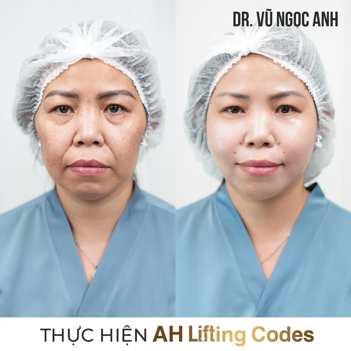 Dịch vụ 15 khách hàng sau khi thực hiện liệu trình AH Lifting Codes 5
