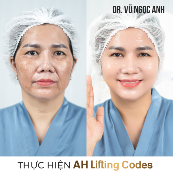 Dịch vụ 13 khách hàng sau khi thực hiện liệu trình AH Lifting Codes 3