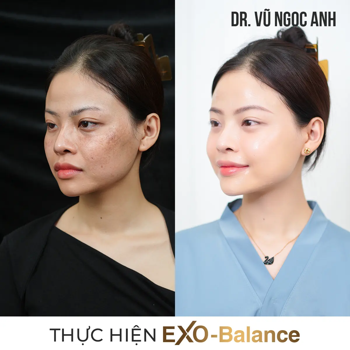 Dịch vụ 10 khách hàng sau khi thực hiện liệu trình Điều Trị Nám EXO - Balance 1