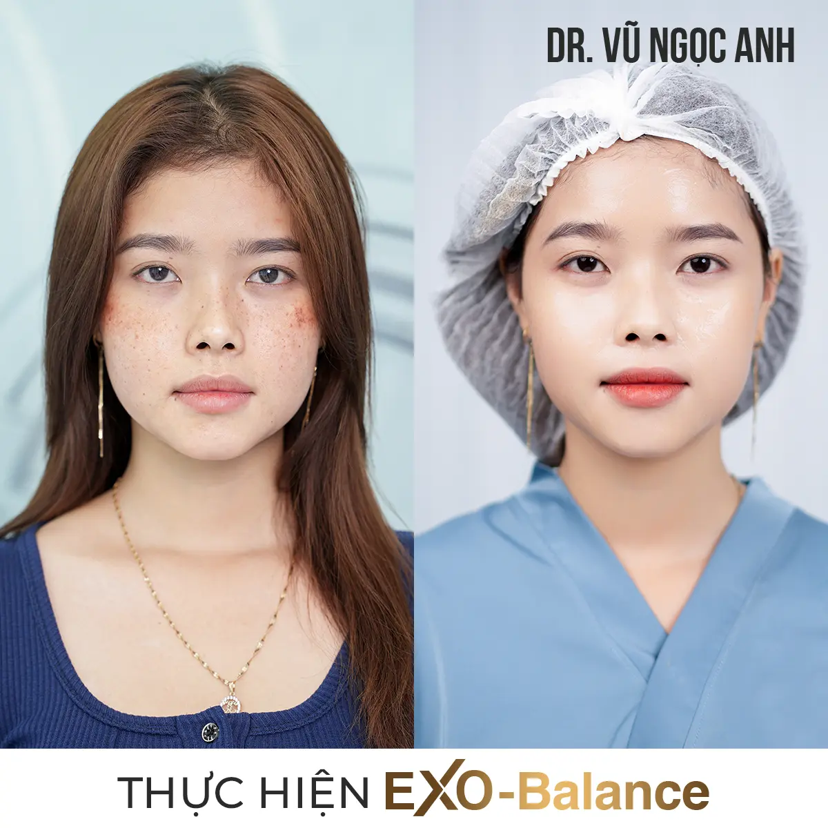 Dịch vụ 21 khách hàng sau khi thực hiện liệu trình Điều Trị Nám EXO - Balance 2