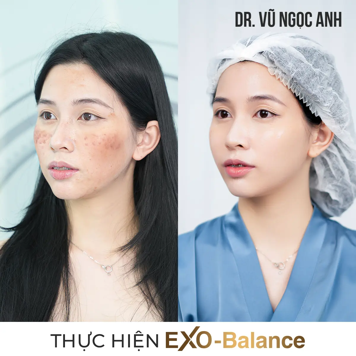 Dịch vụ 20 khách hàng sau khi thực hiện liệu trình Điều Trị Nám EXO - Balance 3
