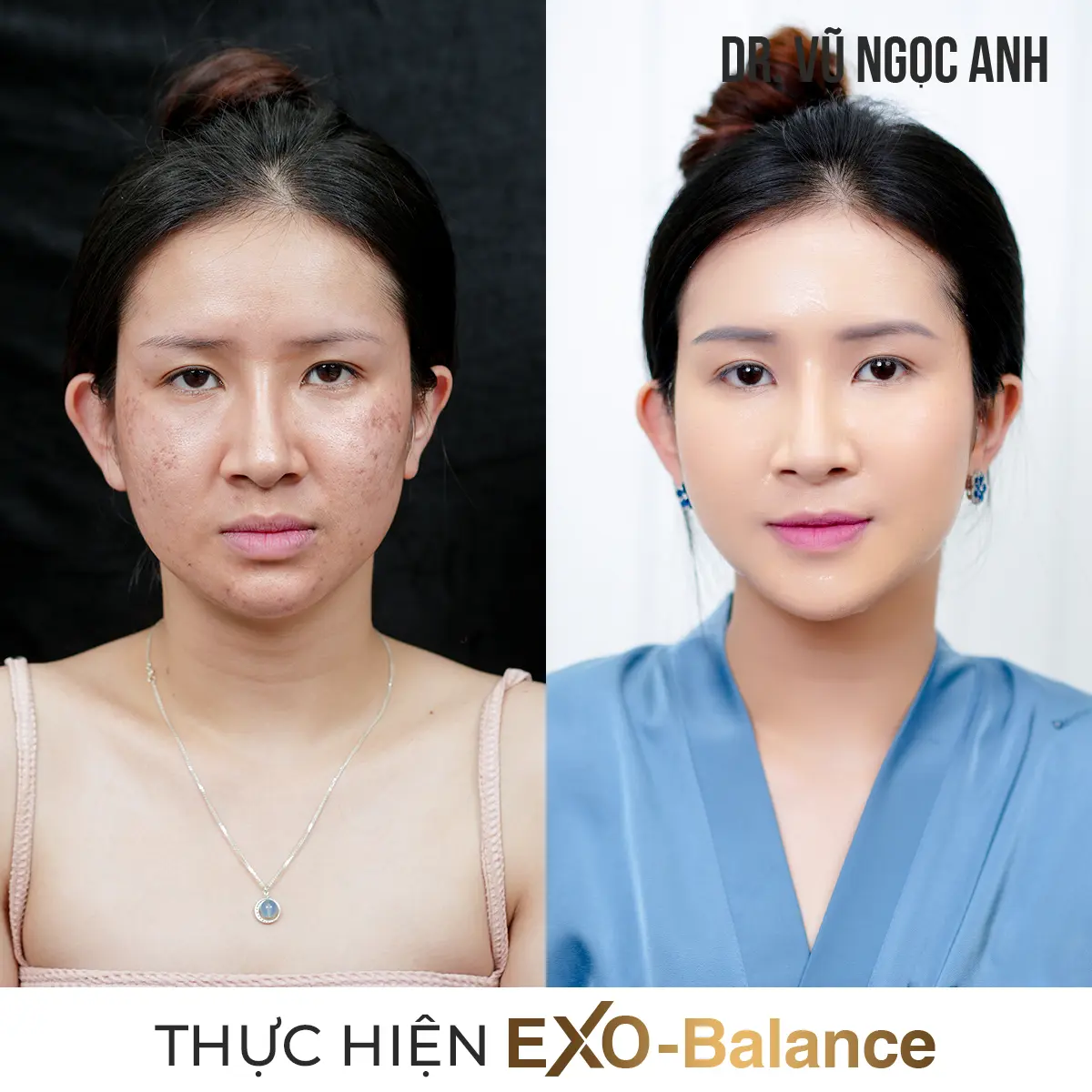 Dịch vụ 19 khách hàng sau khi thực hiện liệu trình Điều Trị Nám EXO - Balance 4