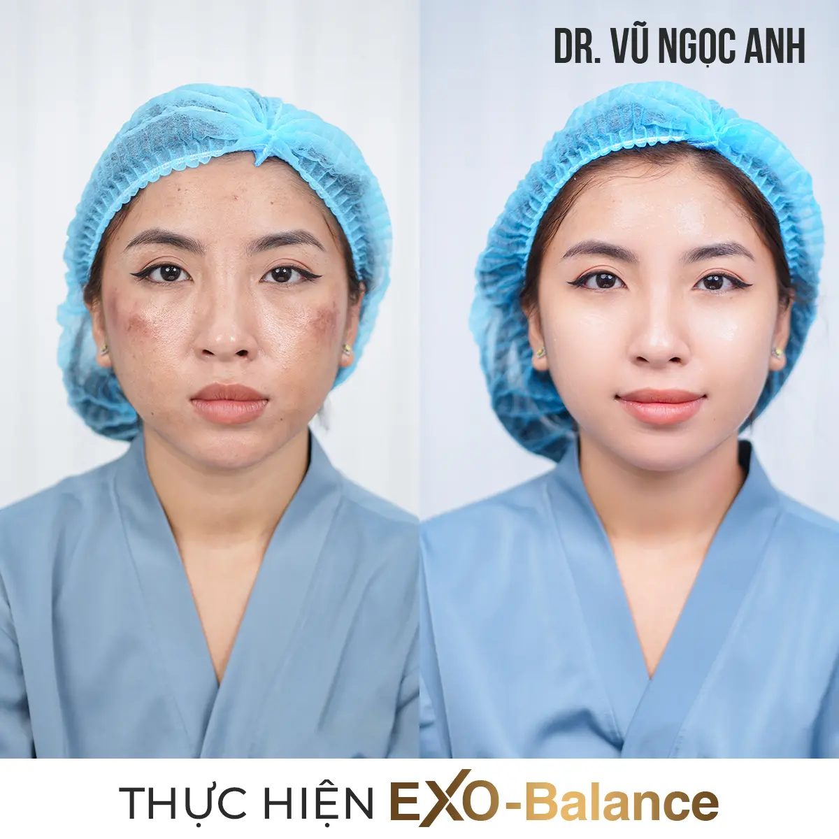 Dịch vụ 18 khách hàng sau khi thực hiện liệu trình Điều Trị Nám EXO - Balance 5
