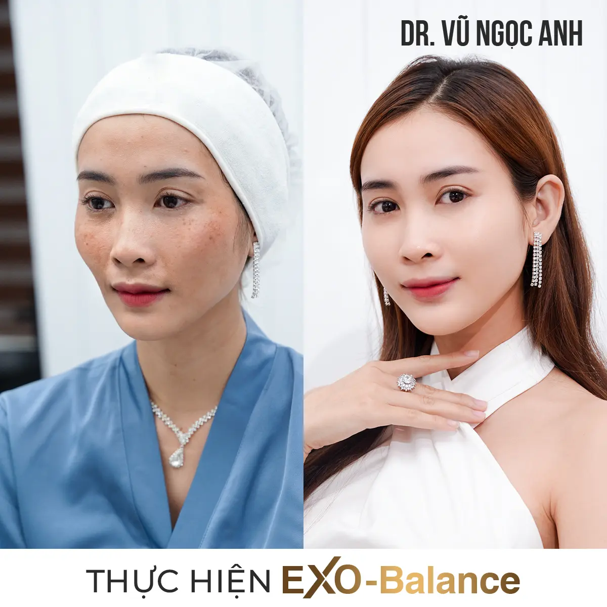 Dịch vụ 17 khách hàng sau khi thực hiện liệu trình Điều Trị Nám EXO - Balance 6
