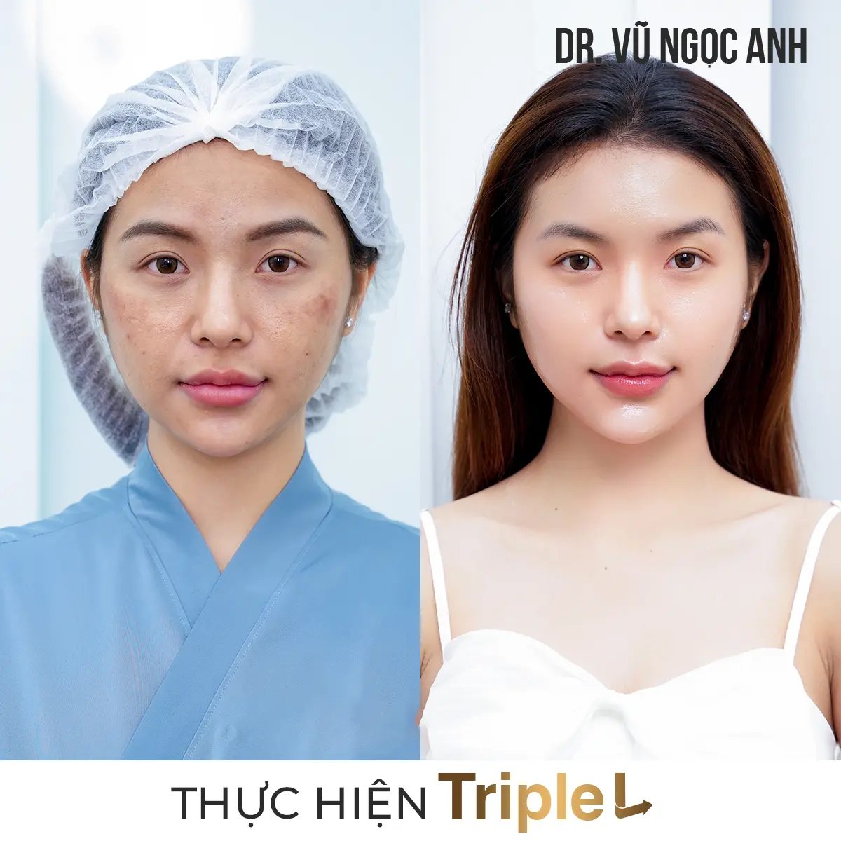 Dịch vụ 4 khách hàng sau khi thực hiện liệu trình Căng bóng da Triple L 5