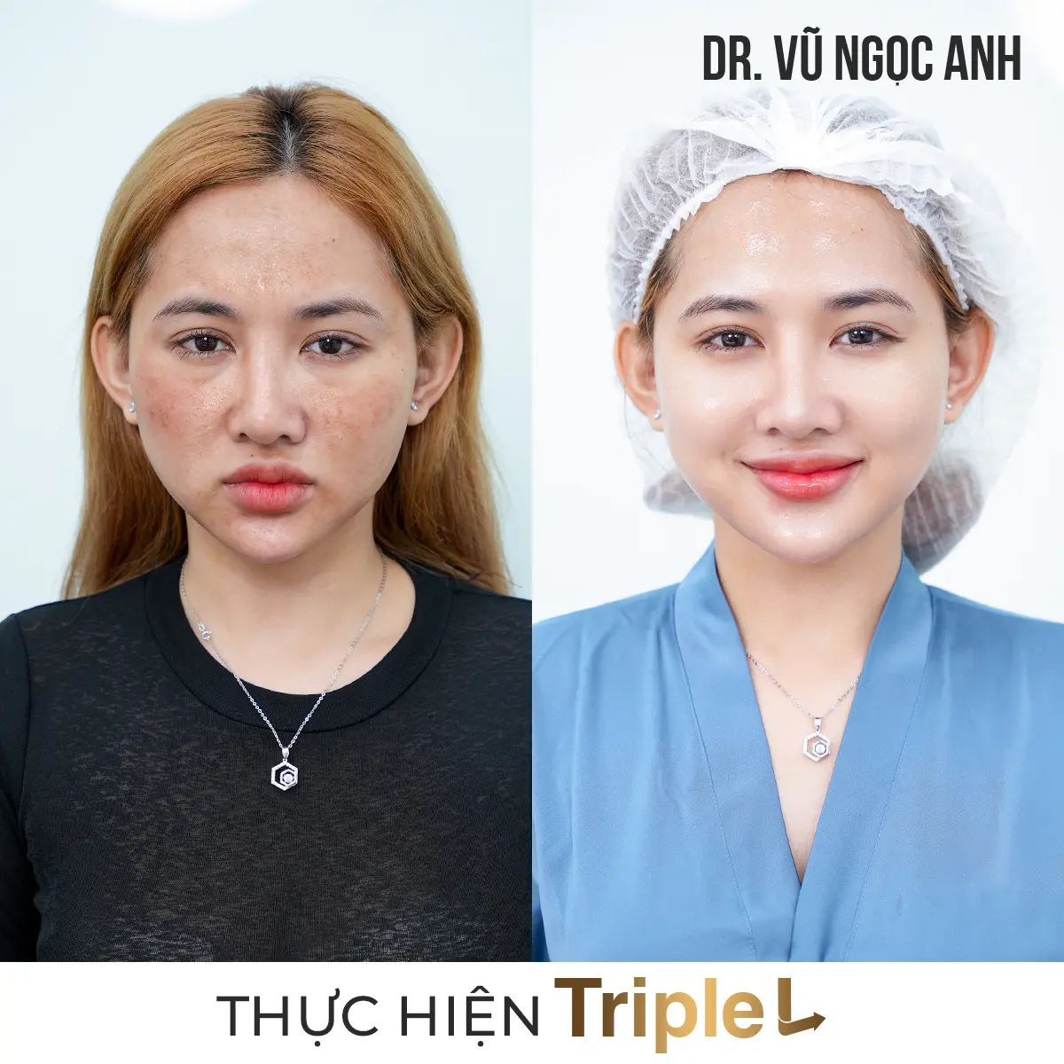Dịch vụ 8 khách hàng sau khi thực hiện liệu trình Căng bóng da Triple L 6
