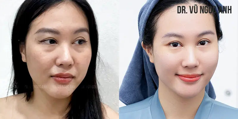 khách hàng thực hiện căng bóng da triple L 4