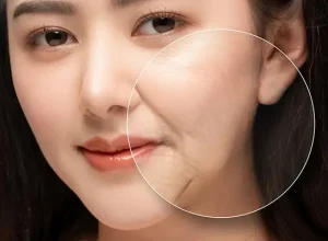 Cách giảm nếp nhăn rãnh cười