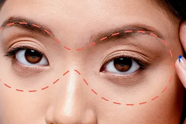 Cấy Mỡ Hốc Mắt Là Gì?