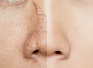 Điều Trị Nám Da Mặt Và Tàn Nhang Ở Đâu Uy Tín