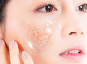 Cách điều trị nám mảng và bảng giá dịch vụ điều trị nám