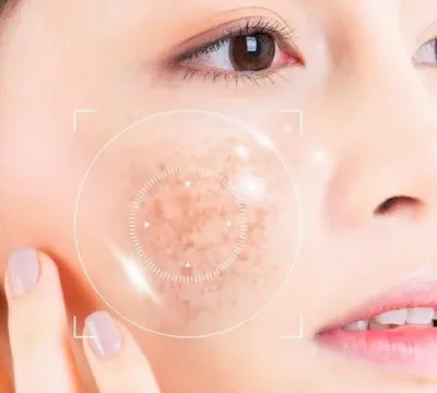 Cách điều trị nám mảng và bảng giá dịch vụ điều trị nám