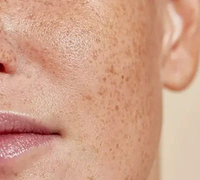 Cách trị nám da mặt hiệu quả cho người bị nám lâu năm