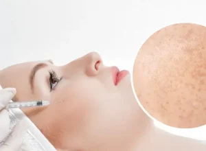 Các phương pháp tiêm trị nám