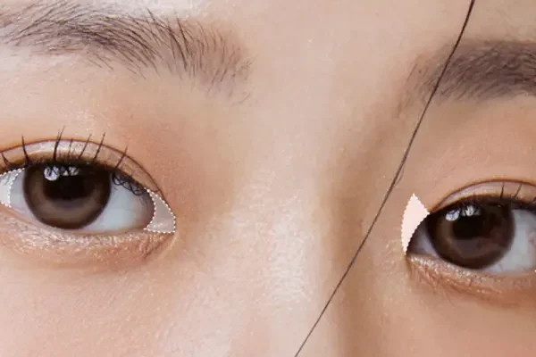 Phẫu Thuật Mở Góc Mắt Là Gì?