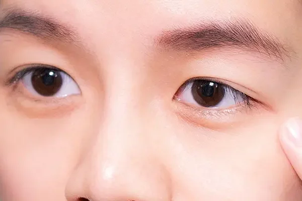Vì sao tự nhiên bị sụp mí mắt?