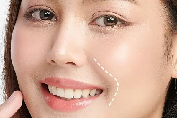 Xóa Rãnh Cười Vĩnh Viễn Được Không?